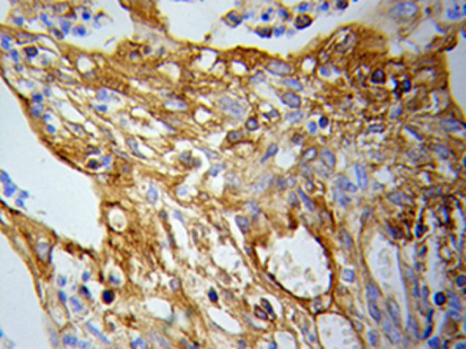 Иммуногистохимия: залитый в парафин рак легкого, препарат окрашен антителами anti-PKM1/2 antibody